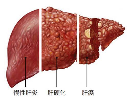 0426_153403_986.png 慢性肝炎-肝硬化-肝癌.png